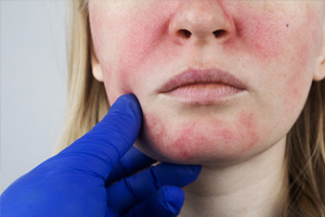 Rosacea